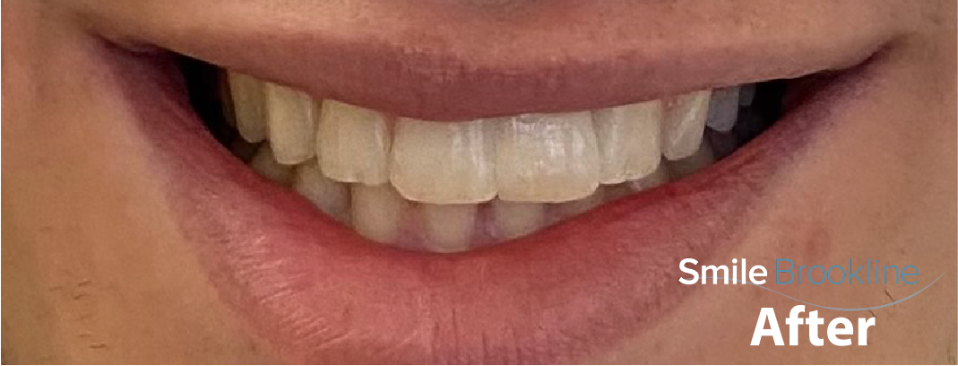 implant-after