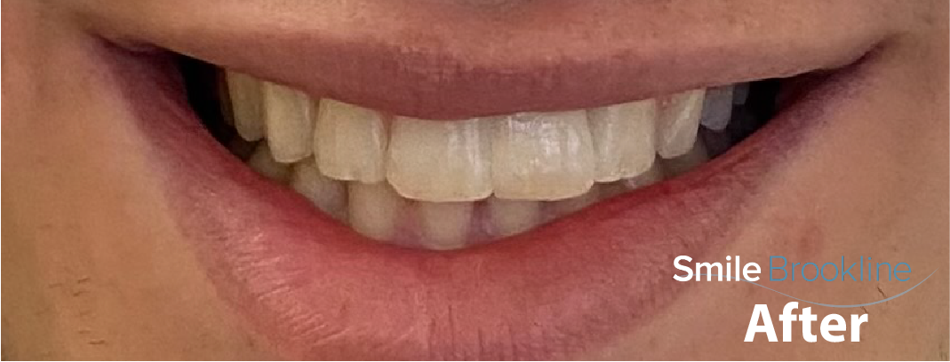 implant-after